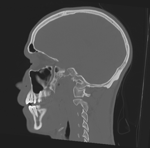 Anterior nasal spine fracture (Radiopaedia 46138-50494 Sagittal bone window 35).png