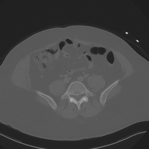 Anterior superior iliac spine avulsion fracture (Radiopaedia 44541-48244 Axial bone window 68).png