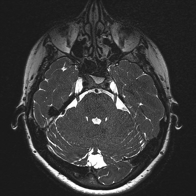 Anterior temporal encephalocele (Radiopaedia 82624-96808 Axial T2 high res 39).jpg