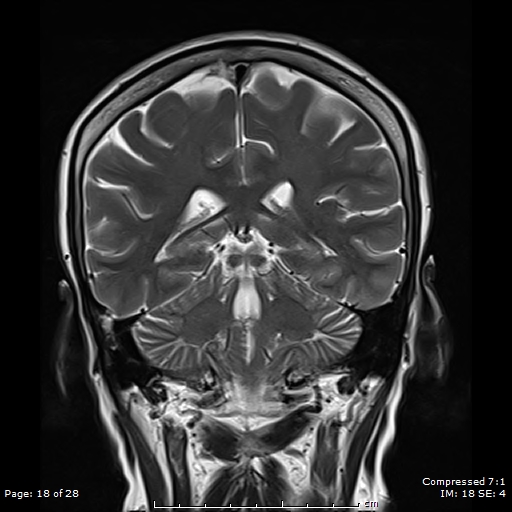 File:Anterior temporal lobe perivascular space (Radiopaedia 88283-104914 Coronal T2 18).jpg