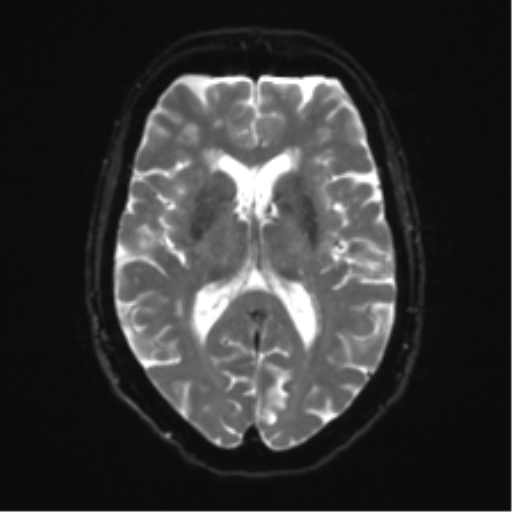 Anterior temporal pole cysts (Radiopaedia 46629-51102 Axial DWI 15).png