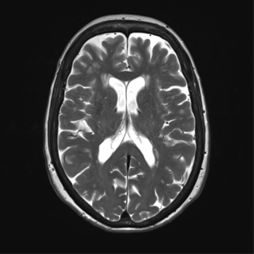 File:Anterior temporal pole cysts (Radiopaedia 46629-51102 C 22).png