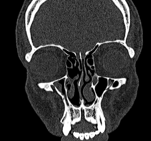 Antrochoanal polyp (Radiopaedia 30002-30554 Coronal bone window 27).jpg