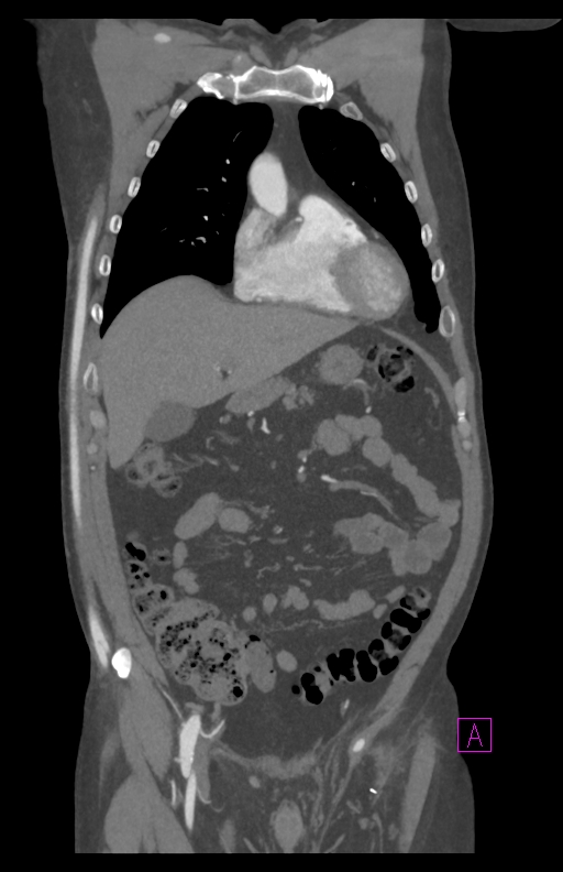 Aortectomy and axillary-bifemoral bypass (Radiopaedia 28303-28545 C 30).jpg
