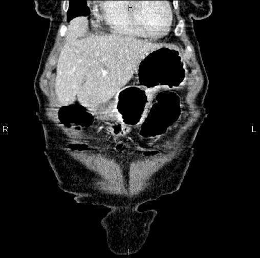 Aortic aneurysm and Lemmel syndrome (Radiopaedia 86499-102554 C 9).jpg