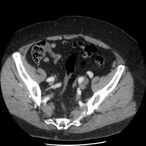 File:Aortic aneurysm and dissection - Stanford type A (Radiopaedia 36693-38261 A 86).png