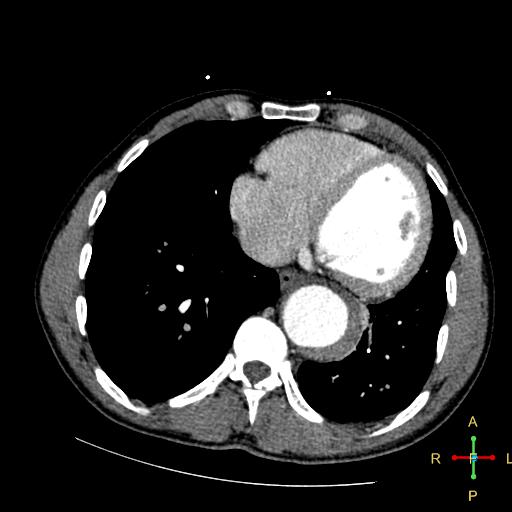 File:Aortic aneurysm and penetrating ulcer (Radiopaedia 23590-23704 A 23).jpg