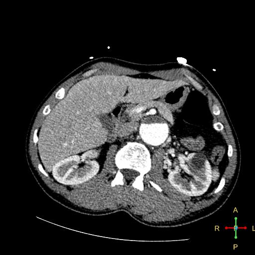 File:Aortic aneurysm and penetrating ulcer (Radiopaedia 23590-23704 A 33).jpg