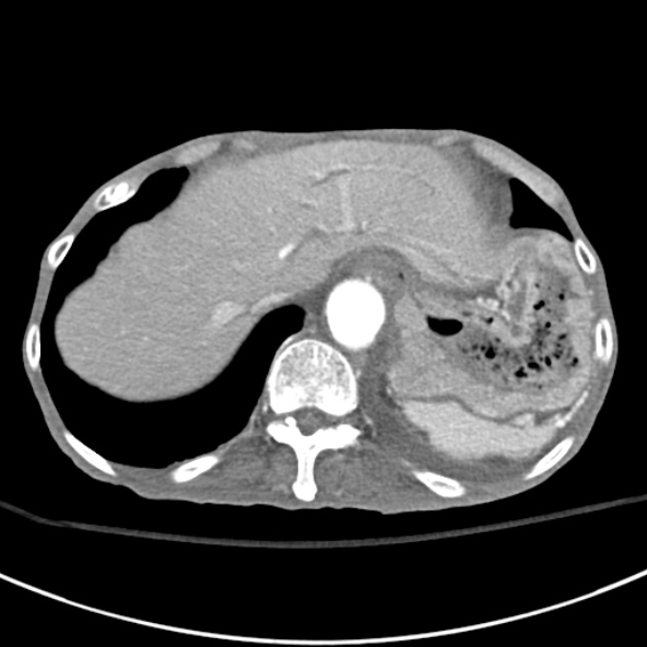 File:Aortic aneurysm with spinal destruction (Radiopaedia 42301-45410 A 15).jpg