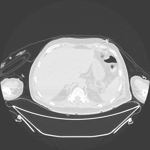Aortic arch aneurysm (Radiopaedia 84109-99365 Axial lung window 256).jpg