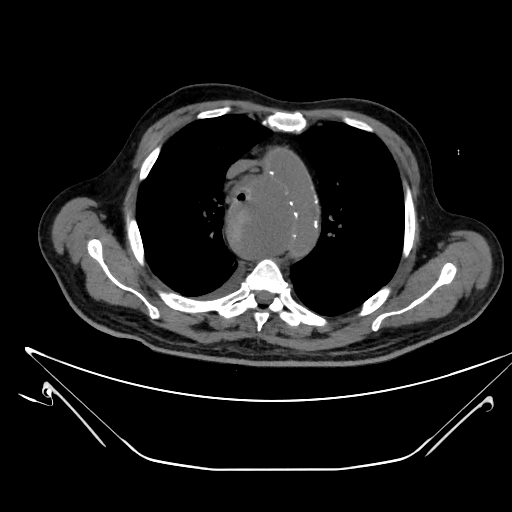 Aortic arch aneurysm (Radiopaedia 84109-99365 Axial non-contrast 96).jpg