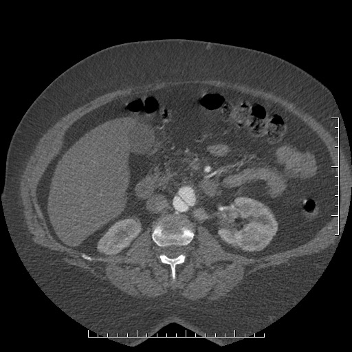 Aortic dissection- Stanford A (Radiopaedia 35729-37268 B 70).jpg