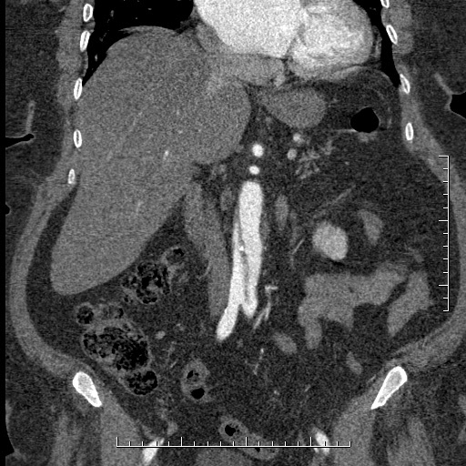 File:Aortic dissection- Stanford A (Radiopaedia 35729-37268 F 37).jpg