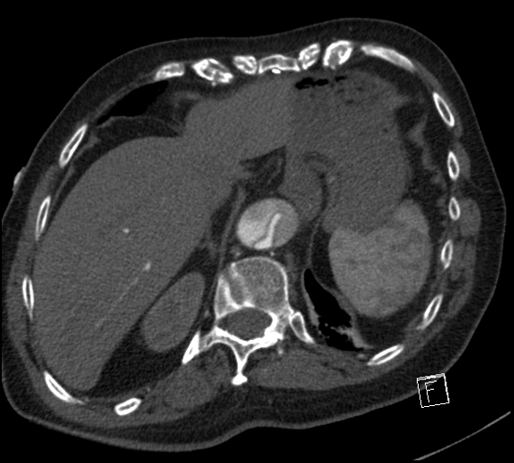 Aortic dissection (CTPA) (Radiopaedia 75506-86750 A 80).jpg