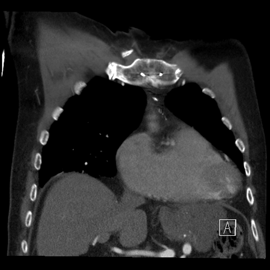 File:Aortic dissection (CTPA) (Radiopaedia 75506-86750 B 19).jpg