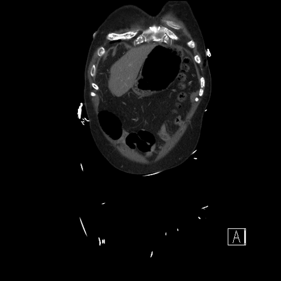 File:Aortic dissection (CTPA) (Radiopaedia 75506-86750 F 3).jpg