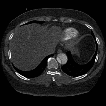 Aortic dissection (Radiopaedia 57969-64959 A 244).jpg