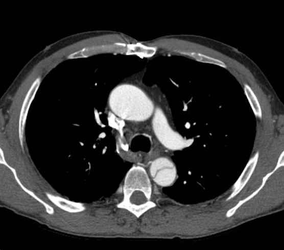 File:Aortic dissection - Stanford type B (Radiopaedia 73648-84437 A 34).jpg