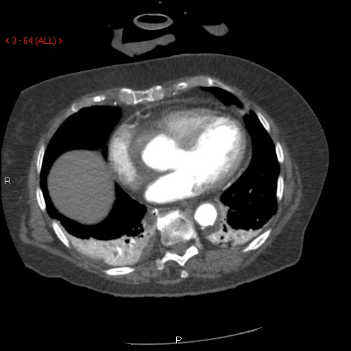 Aortic intramural hematoma (Radiopaedia 27746-28001 A 64).jpg