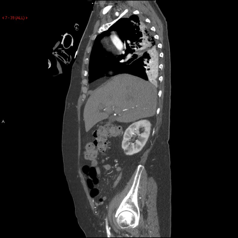 Aortic intramural hematoma (Radiopaedia 27746-28001 C 8).jpg