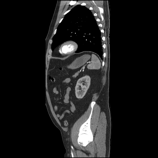 Aortic intramural hematoma (type B) (Radiopaedia 79323-92387 H 43).jpg