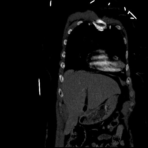 Aortic intramural hematoma from penetrating atherosclerotic ulcer (Radiopaedia 31137-31836 C 12).jpg