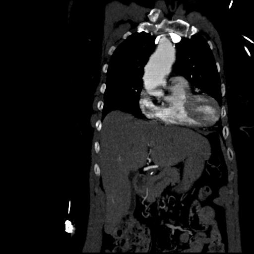 File:Aortic intramural hematoma from penetrating atherosclerotic ulcer (Radiopaedia 31137-31836 C 17).jpg