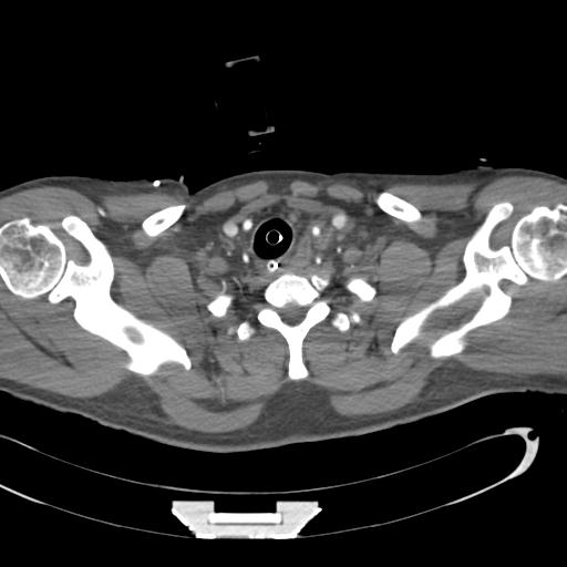 Aortic transection, diaphragmatic rupture and hemoperitoneum in a complex multitrauma patient (Radiopaedia 31701-32622 A 8).jpg