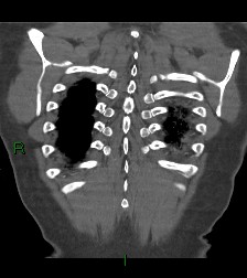 Aortic valve endocarditis (Radiopaedia 87209-103485 D 9).jpg