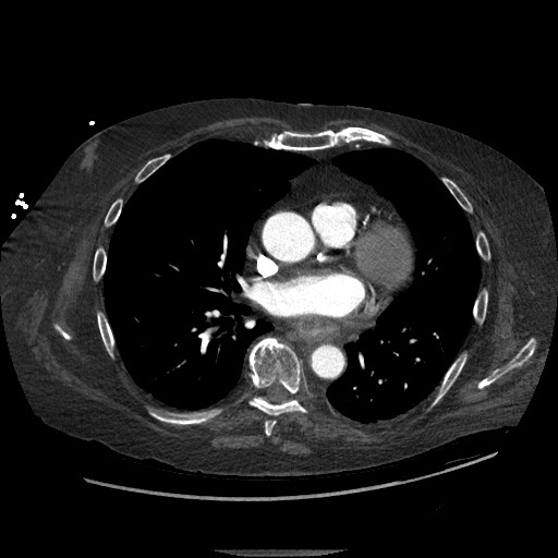 Aortoesophageal fistula with endovascular repair (Radiopaedia 73781-84592 Axial C+ CTPA 87).jpg