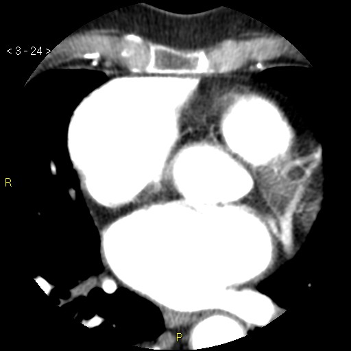 Aortoiliac occlusive disease (Radiopaedia 16828-16548 A 24).jpg