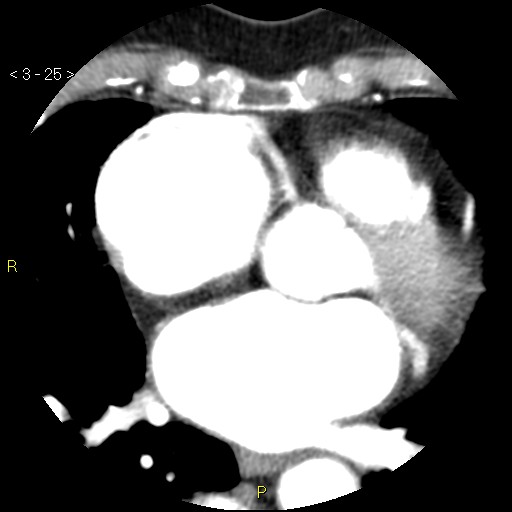 Aortoiliac occlusive disease (Radiopaedia 16828-16548 A 25).jpg