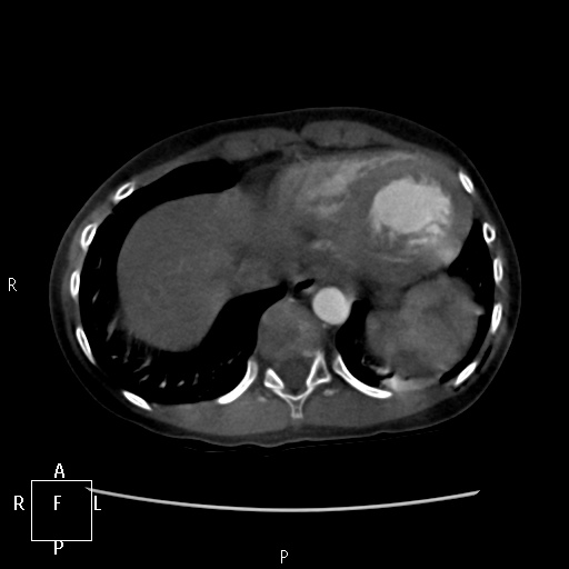File:Aortopulmonary septal defect (Radiopaedia 41990-45013 Axial C+ CTPA 9).jpg