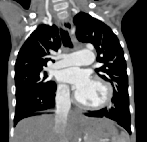 File:Aortopulmonary window, interrupted aortic arch and large PDA giving the descending aorta (Radiopaedia 35573-37074 D 35).jpg