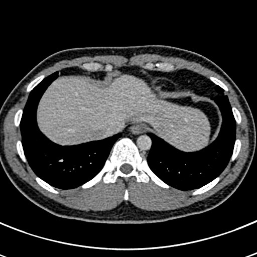 Apical lung mass mimic - neurogenic tumor (Radiopaedia 59918-67521 A 68).jpg