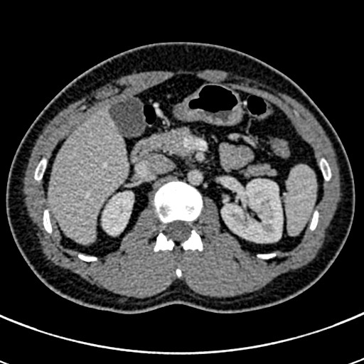 Apical lung mass mimic - neurogenic tumor (Radiopaedia 59918-67521 A 93).jpg