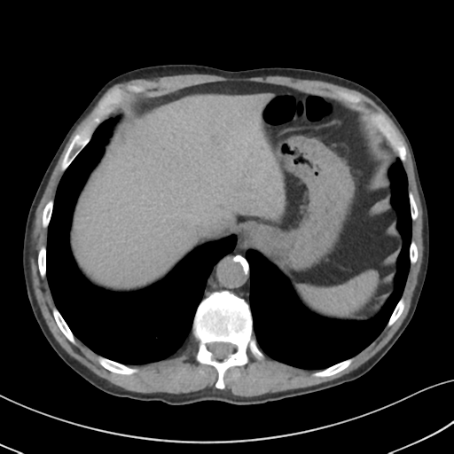 Apical pulmonary metastasis (Radiopaedia 46338-50754 B 55).png