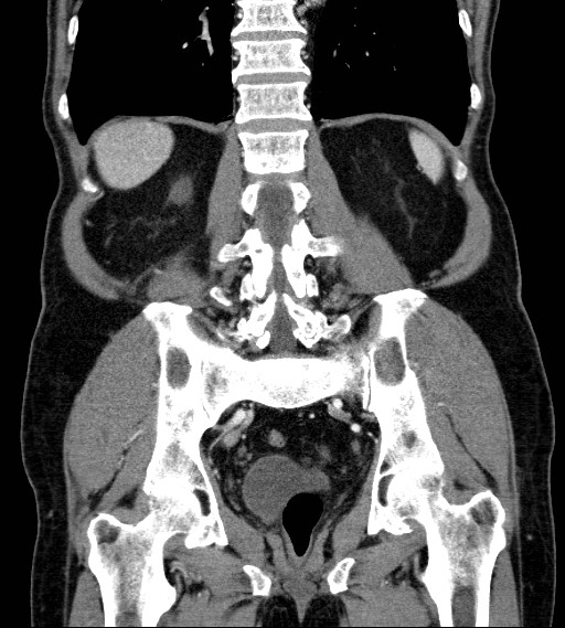 Appendiceal adenocarcinoma complicated by retroperitoneal abscess (Radiopaedia 58007-65039 A 63).jpg
