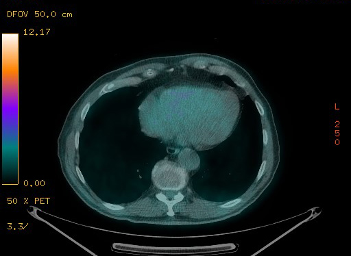 Appendiceal adenocarcinoma complicated by retroperitoneal abscess (Radiopaedia 58007-65041 Axial PET-CT 91).jpg
