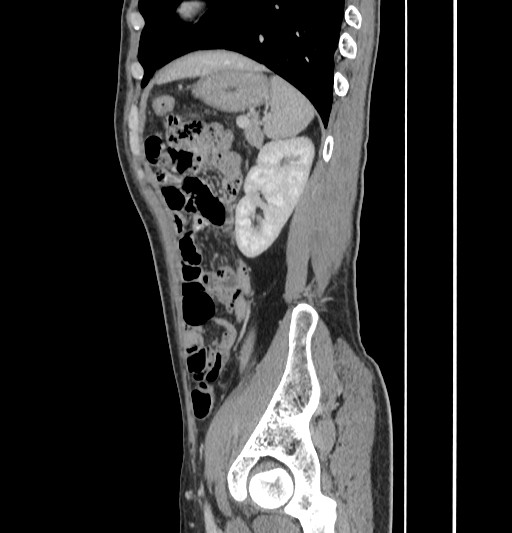 Appendiceal mucinous adenocarcinoma (Radiopaedia 66605-75922 C 52).jpg