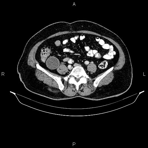 File:Appendiceal mucocele (Radiopaedia 82952-97298 B 72).jpg