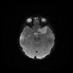 File:Arachnoid cyst - middle cranial fossa (Radiopaedia 86780-102938 Axial DWI 48).jpg