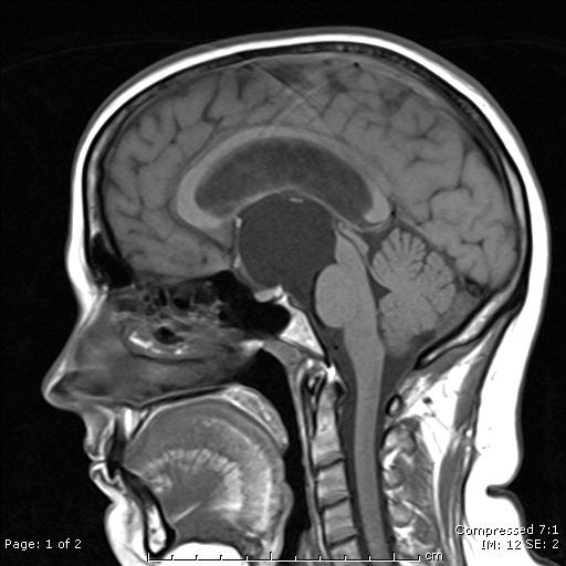 File:Arachnoid cyst distorting the third ventricle (Radiopaedia 6111-7583 Sagittal T1 1).jpg