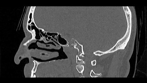 Arcuate foramen (Radiopaedia 89833-106944 Sagittal bone window 39).jpg