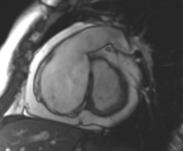 File:Arrhythmogenic right ventricular cardiomyopathy (Radiopaedia 69431-79307 Short axis cine 198).jpg