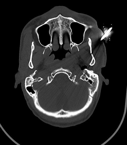 Arrow injury to the face (Radiopaedia 73267-84011 Axial bone window 41).jpg