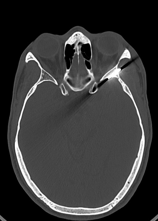 Arrow injury to the head (Radiopaedia 75266-86388 Axial bone window 66).jpg