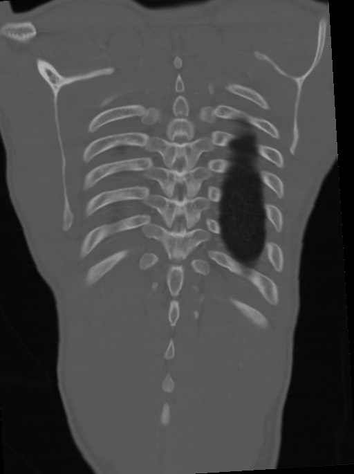 Arrow injury to the neck (Radiopaedia 75225-86323 Coronal bone window 102).jpg
