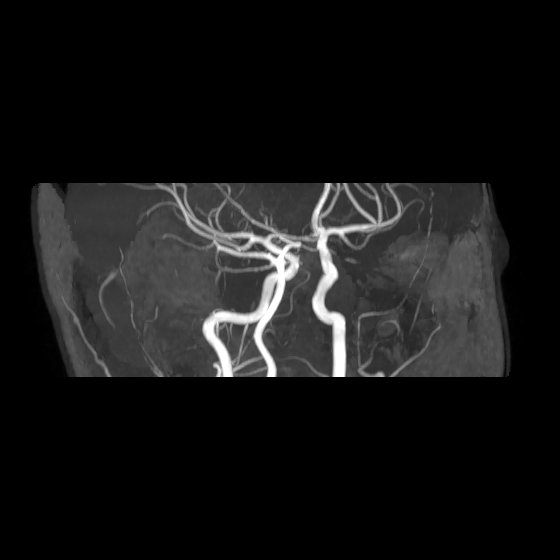 File:Artery of Percheron infarct (Radiopaedia 40966-43676 G 19).jpg