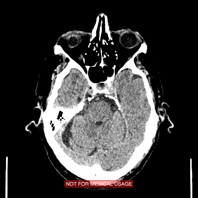 Artery of Percheron infarction (Radiopaedia 28679-28967 Axial non-contrast 36).jpg